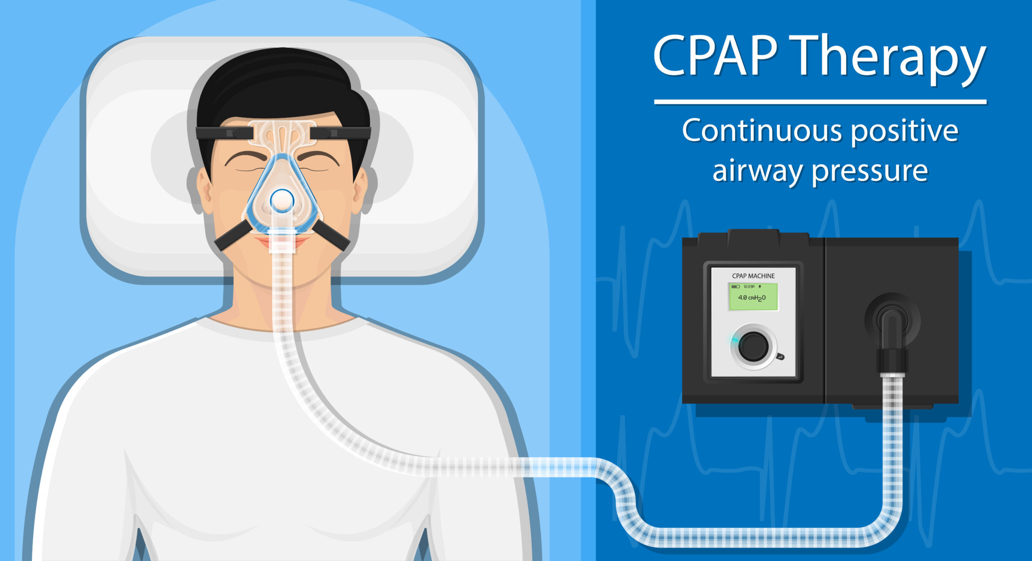 Global Continuous Positive Airway Pressure Devices Market Trends to Register 7.20% CAGR over 2030