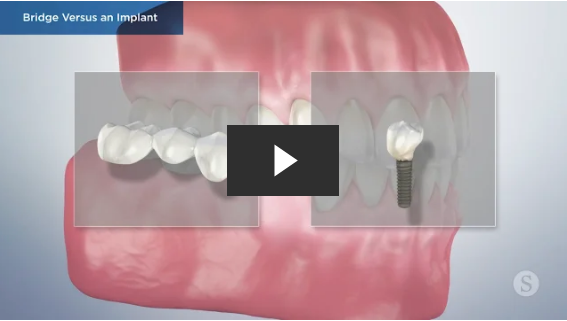Reviving Your Smile: The Magic of Dental Implants