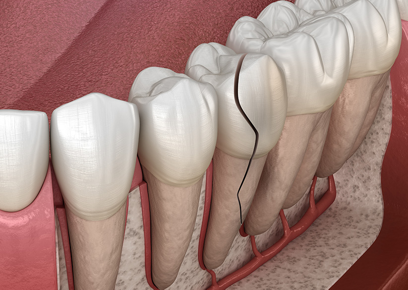 A Dentist’s Guide to Diagnosing Tooth Fractures