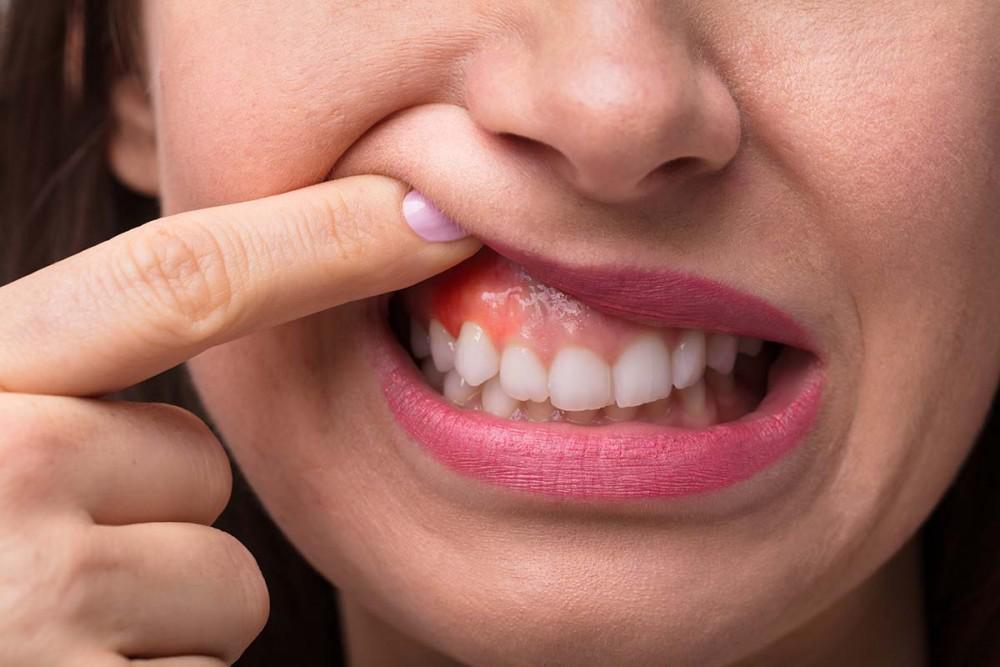Unlocking the Potential: Can You Use Keflex for Tooth Infection?