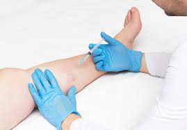 Exploring the Different Methods to Get Rid of Varicose Veins without Surgery